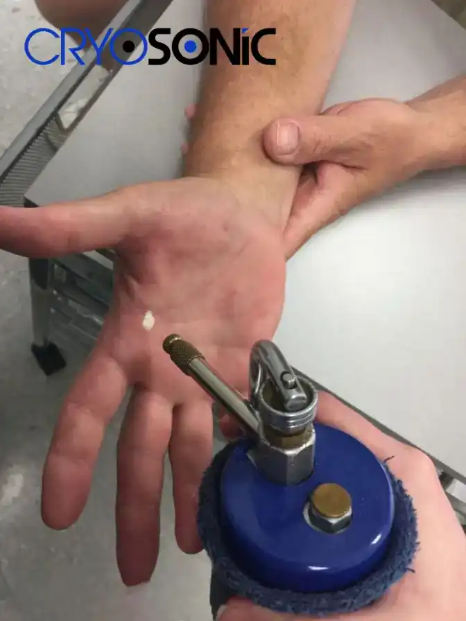 Temperature Differences: OTC vs Medical-Grade Cryotherapy England
